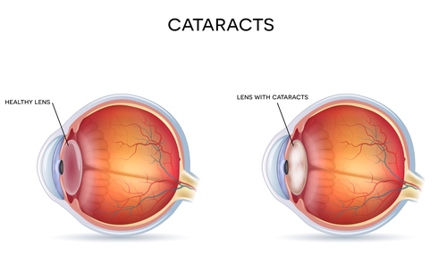 cataracts in dogs