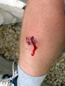 Level 4 dog bite with deep puncture and bruising